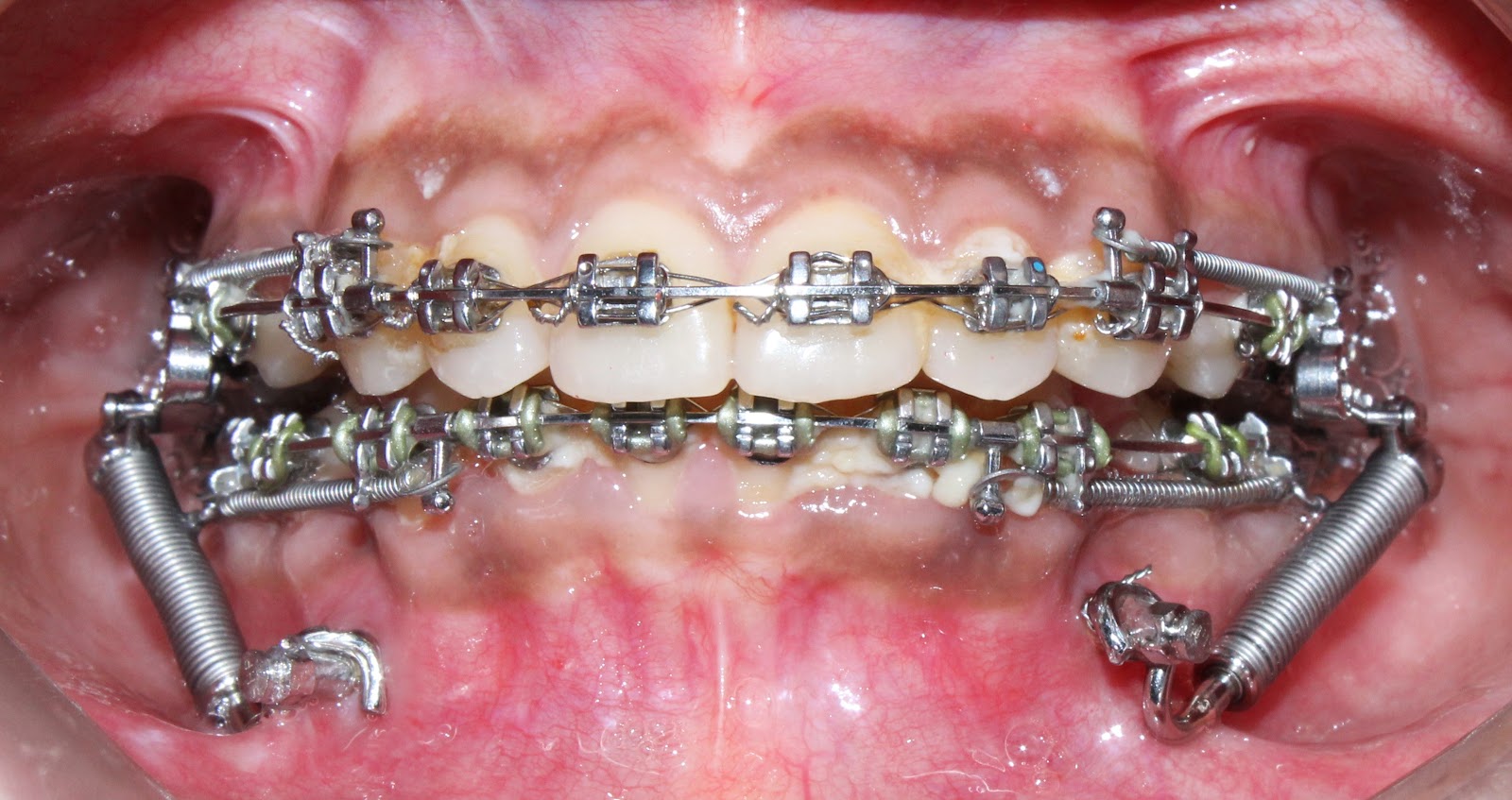 Painless extraction treatment room